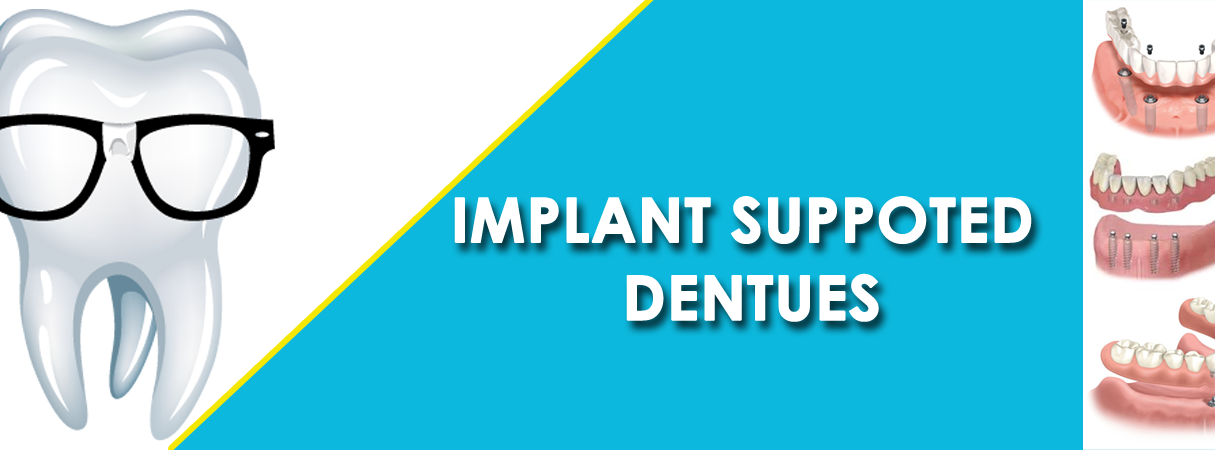 Implant Suppoted Dentues