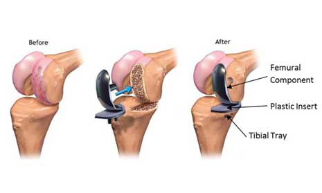 knee replacement surgery Indore