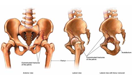 Indore total hip replacement