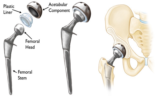 Orthopedic surgery in Indore