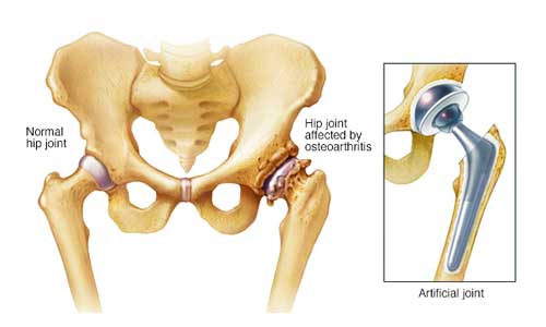 total hip replacement Indore