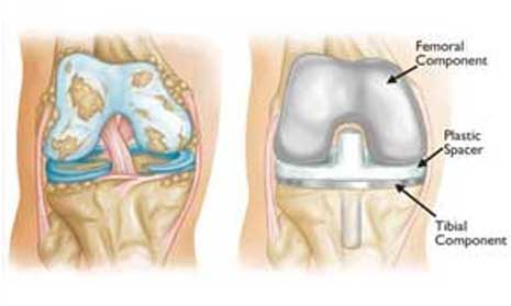 Joint Replacement doctor Indore