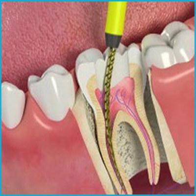 Advanced Root Canal Treatment