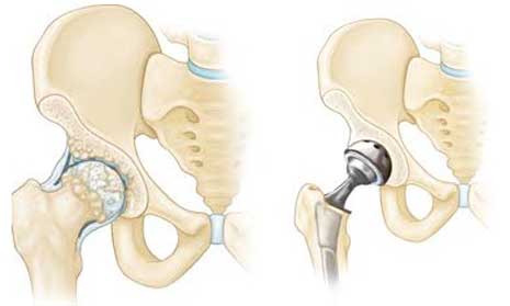 Indore total hip replacement