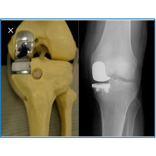 Joint replacement surgeon in Indore