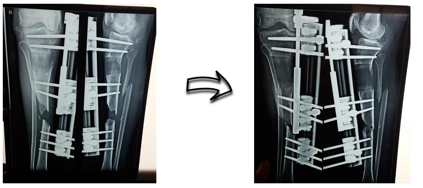 Indore total knee replacement