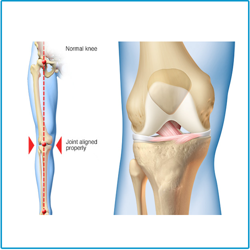 knee replacement surgery Indore