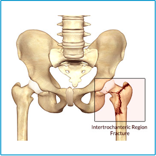 Joint Replacement doctor Indore