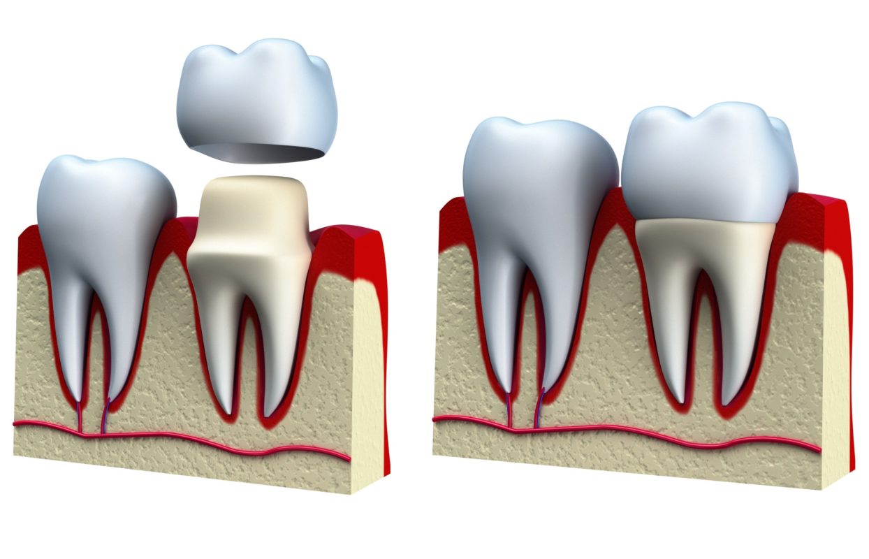 Complete Dentures/Partial Dentures