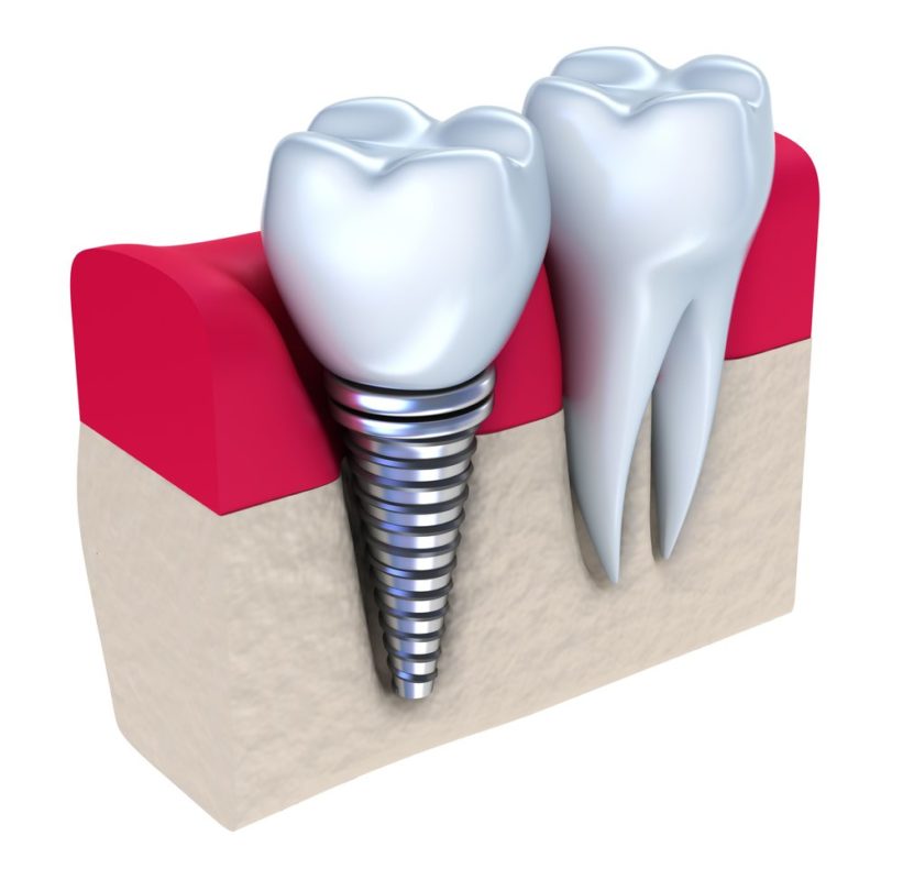 Advanced Root Canal Treatment