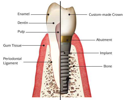 Dental implants