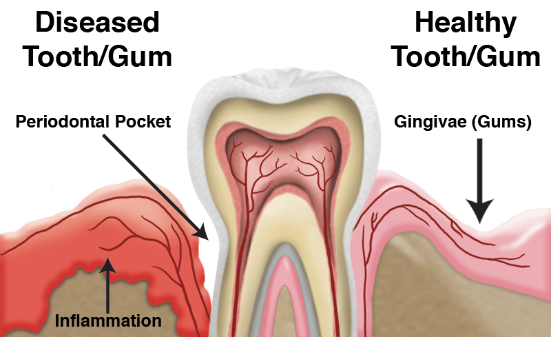 Advanced Root Canal Treatment