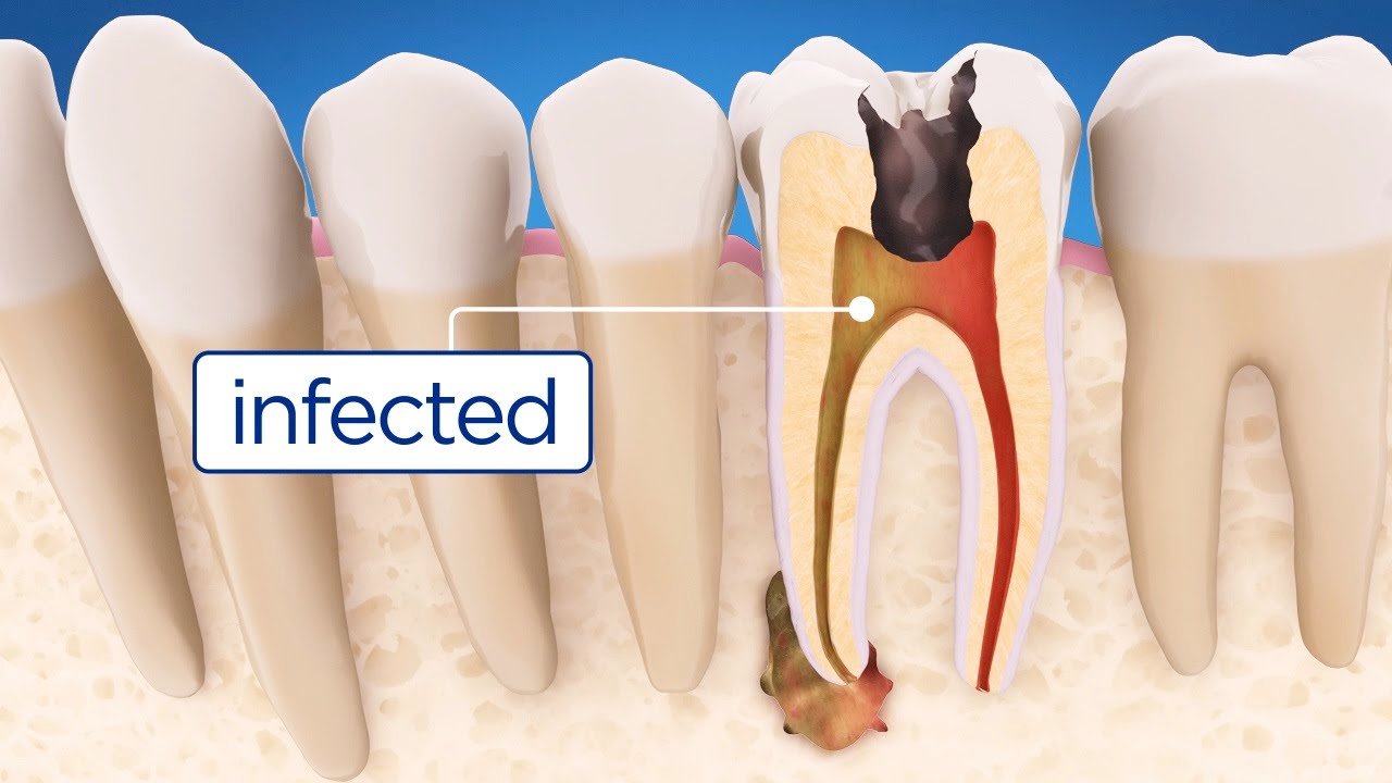 Root canal treatment