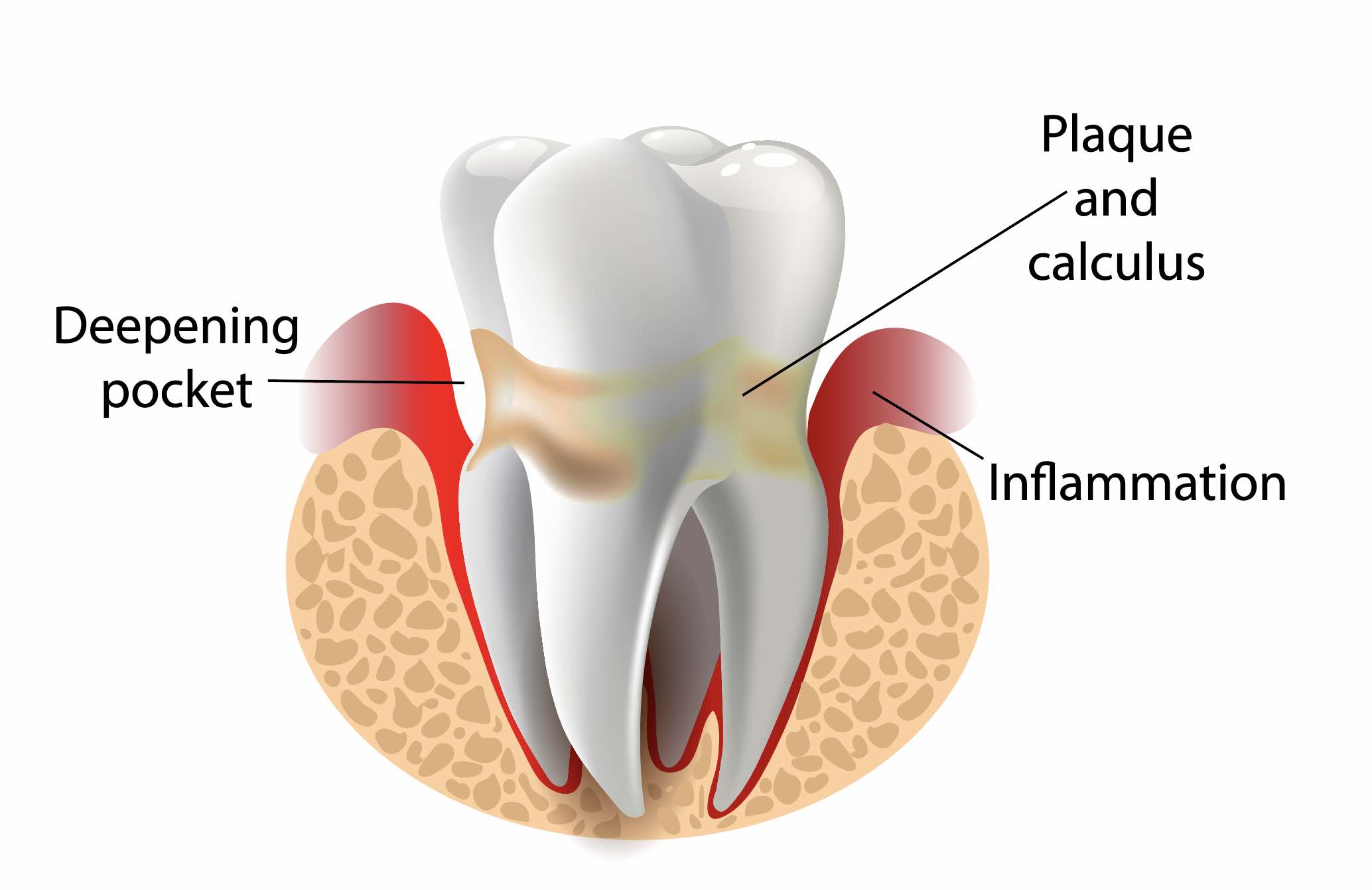 Gum disease